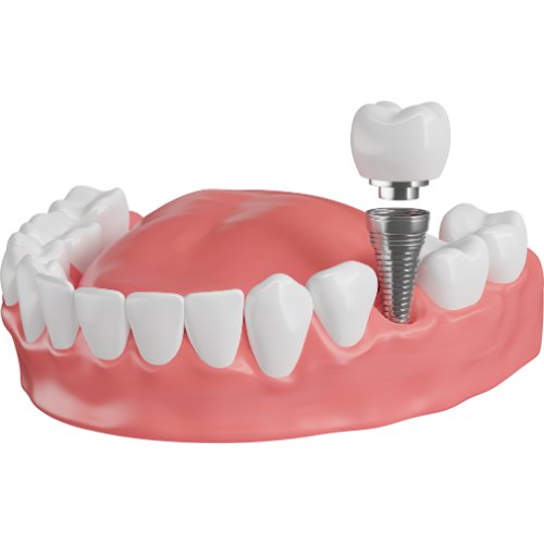 Implantate