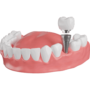 Implantate